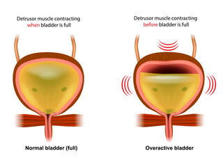 Overactive bladder OAB and Normal bladder. 
llustration showing Detrusor muscle contracting when and before bladder is full. Urology 