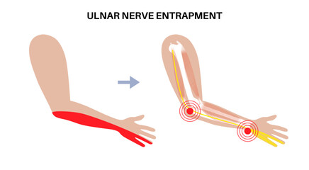 Ulnar nerve entrapment