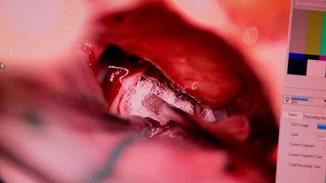 Metal tools work in the inner organ during surgery. Part of the picture on the screen in operational room. Close up.