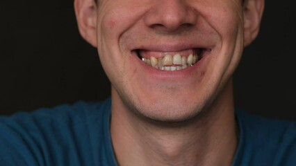 A man's crooked teeth. Young man showing crooked growing teeth. The man needs to go to the dentist to install braces.