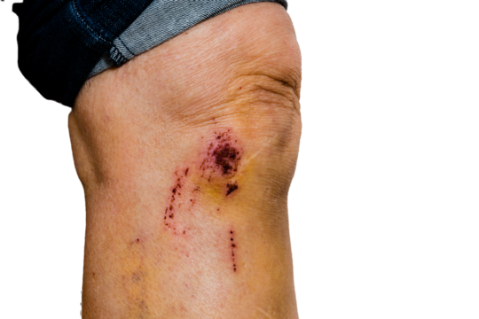 woman with knee pain