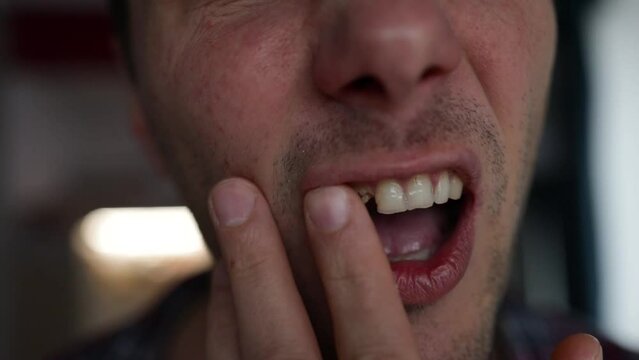 close-up shot of a toothless male mouth. A man with bad teeth. Man showing his rotten teeth, caries, decayed and weak enamel, teeth falling out, dental problems.