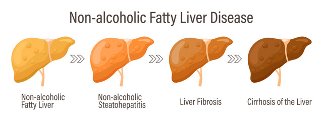 Types of fatty liver. Human liver diseases. Non-alcoholic fatty liver disease. Hepatitis, liver cirrhosis, fibrosis, steatosis. Medical infographic banner. Vector - obrazy, fototapety, plakaty