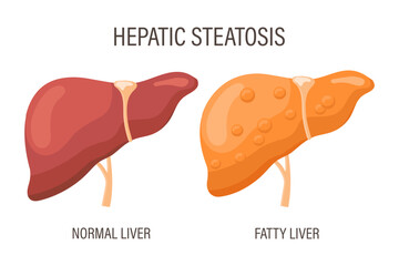 Liver steatosis, liver diseases. Healthy liver and fatty liver. Medical infographic banner. Vector - obrazy, fototapety, plakaty