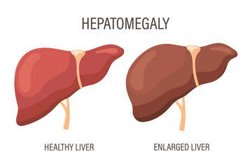 Hepatomegaly, liver diseases. Healthy liver and enlarged liver. Medical infographic banner. Vector - obrazy, fototapety, plakaty