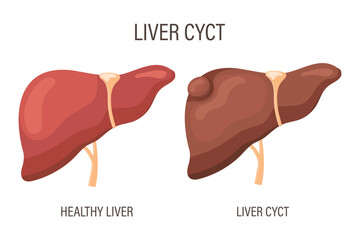 Liver cyst, liver disease. Healthy liver and liver cyst. Medical infographic banner. Vector - obrazy, fototapety, plakaty