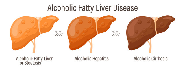 Types of fatty liver. Human liver diseases. Alcoholic fatty liver disease. Hepatitis, liver cirrhosis, fibrosis, steatosis. Medical infographic banner. Vector - obrazy, fototapety, plakaty