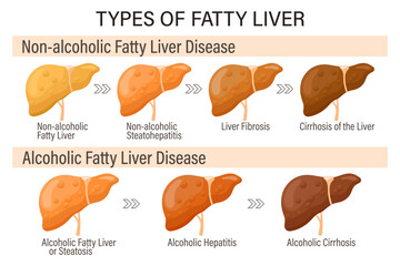 Types of fatty liver. Human liver diseases. Alcoholic and non-alcoholic fatty liver. Hepatitis, liver cirrhosis, fibrosis, steatosis. Medical infographic banner. Vector - obrazy, fototapety, plakaty