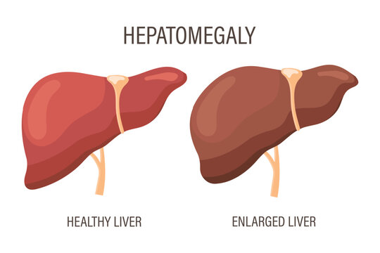 Hepatomegaly, liver diseases. Healthy liver and enlarged liver. Medical infographic banner. Vector