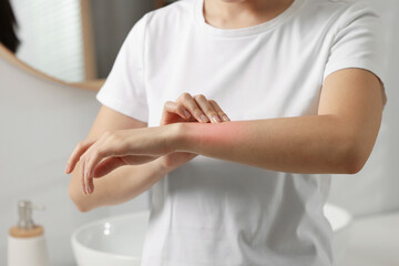 Suffering from allergy. Young woman scratching her arm in bathroom, closeup