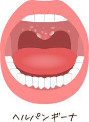 舌、歯、ヘルパンギーナのイラスト、illustration