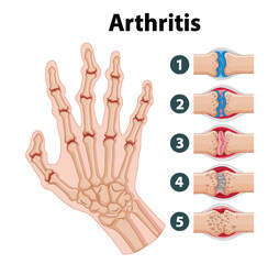 Science Education of Human Anatomy: Arthritis Stages on Hand Infographic