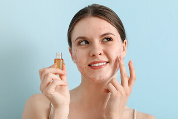 Young woman with acne problem applying oil on blue background, closeup