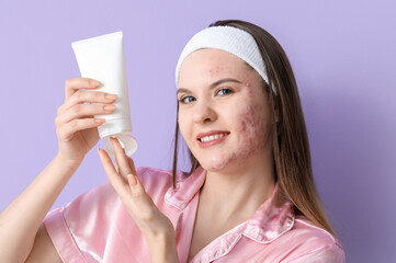 Young woman with acne problem and tube of cream on lilac background, closeup