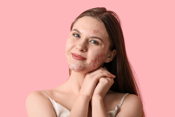 Young woman with acne problem on pink background, closeup