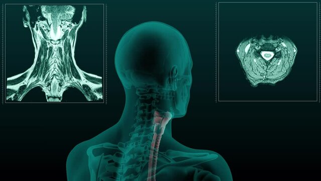 MRI scan of the human head and neck with the trachea and the Larynx visible. 3d render animation of rotation.

