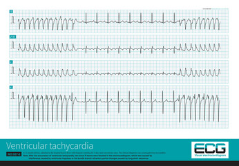 An 11 month old male infant was clinically diagnosed with cytomegalovirus myocarditis. The child experienced a brief atrioventricular block after a ventricular tachycardia attack.