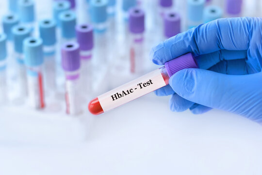 Doctor holding a test blood sample tube with HbA1c test on the background of medical test tubes with analyzes
