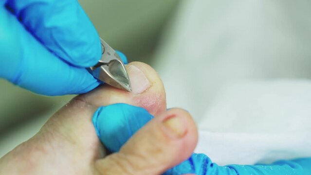 An orthopedic doctor in blue gloves removes dead skin tissue from the nail plate. Close-up.