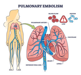 Pulmonary embolism with blood flow blockage in lung artery outline diagram. Labeled educational scheme with clot and thrombus from inferior vena cava vector illustration. Stroke disease and condition - obrazy, fototapety, plakaty