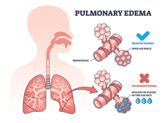Pulmonary edema condition with fluid buildup in air sacs outline diagram. Labeled educational scheme with healthy and disease lungs medical comparison vector illustration. Respiratory bronchiole care - obrazy, fototapety, plakaty