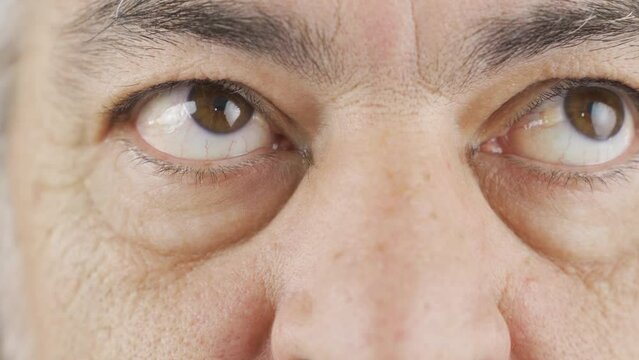 Old man with pinguecula eye condition.