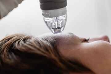 Microneedle RF lifting procedure. Hardware cosmetology.