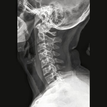 x ray of a human cervical spine lateral view (neck lateral x-ray image)