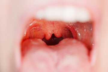 Cleft, bifurcation of the uvula. congenital malformations.