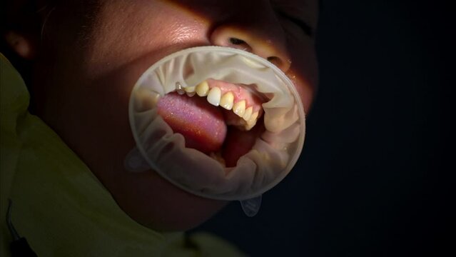 Dolly out shot of a dentist's patient mouth open while getting new ceramic composite veneers.