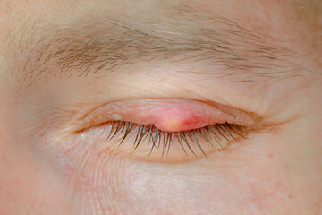 Chalazion, slow-growing lump or cyst that develops within the eyelid. Burst abscess, inflamed area of the eyelid. Eye diseas with swollen, inflamed eyelid. Chalazion on upper eyelid closeup. - obrazy, fototapety, plakaty