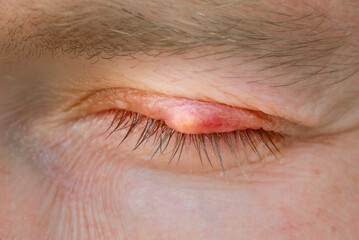 Burst abscess, inflamed area of the eyelid. Chalazion, slow-growing lump or cyst that develops within the eyelid. Eye diseas with swollen, inflamed eyelid. Chalazion on upper eyelid closeup. - obrazy, fototapety, plakaty