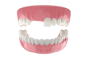 Missing front teeth with full tooth and gums isolated white background.