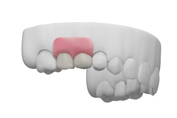 Dentures, false molar tooth with gums isolated white background, 3D rendering.