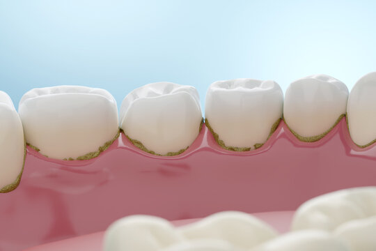 Dental tartar at molar teeth for tartar and tooth plaque removal blue background. 3D rendering.