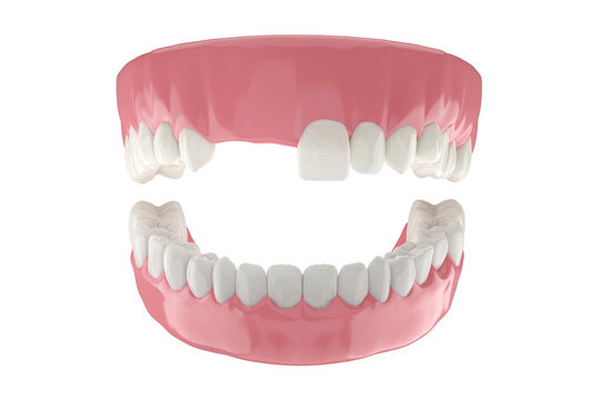 Missing front teeth with full tooth and gums isolated white background.