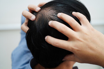 Naklejka premium Bald head in man, hair loss treatment health problem.
