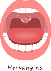 舌、歯、ヘルパンギーナのイラスト、illustration