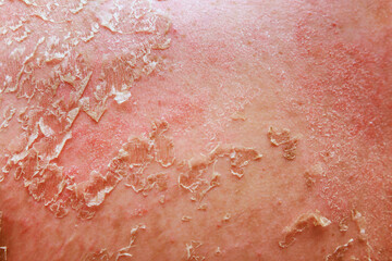 In field of dermatology, psoriatic eczema presents unique challenges for diagnosis treatment.