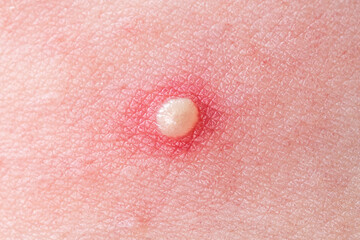 Pimple, acne or comedones. Inflamed pimples, pustules, cysts. Infection on skin. Popping pimple....
