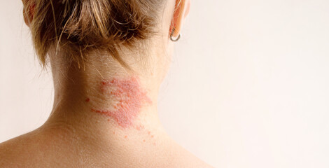 Manifestation of atopic dermatitis as a red itchy spot on a woman’s neck, close-up, rear view, copy space. Dermatology, allergy, itching, red spot or rash on skin - obrazy, fototapety, plakaty