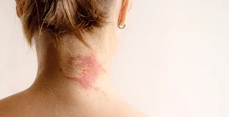 Manifestation of atopic dermatitis as a red itchy spot on a woman’s neck, close-up, rear view, copy space. Dermatology, allergy, itching, red spot or rash on skin © isavira