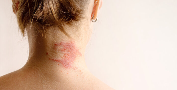 Manifestation of atopic dermatitis as a red itchy spot on a woman’s neck, close-up, rear view, copy space. Dermatology, allergy, itching, red spot or rash on skin