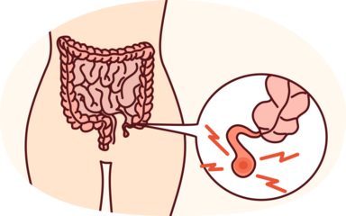 Human body with inflamed appendicitis