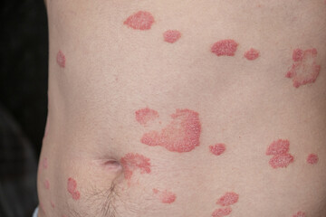 Psoriasis Vulgaris, skin patches are typically red, itchy, and scaly. Papules of chronic psoriasis vulgaris on male hand, back and body. Genetic immune disease. Detail of psoriatic skin disease 