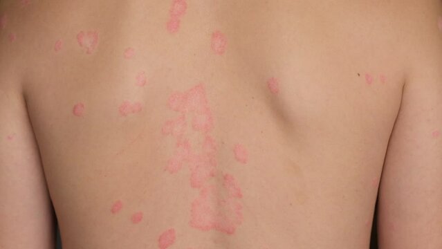 Psoriasis Vulgaris, skin patches are typically red, itchy, and scaly. Papules of chronic psoriasis vulgaris on male hand, back and body. Genetic immune disease. Detail of psoriatic skin disease 