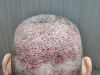 Fototapeta premium allergic photos of the front and back of the head of a man who has had a hair transplant