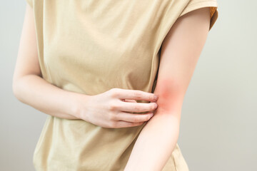 Dermatology asian young woman, girl allergy, allergic reaction from atopic, insect bites on her arm, hand in scratching itchy, itch red spot or rash of skin. Healthcare, treatment of beauty.