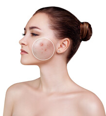 Young woman with zoom circle before and after acne treatment.