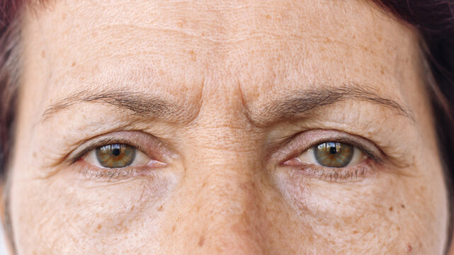 Close up of an elderly caucasian woman's face with puffiness under her eyes, facial wrinkles and pigment spots. Age-related skin changes, fatigue. Cosmetology and beauty concept